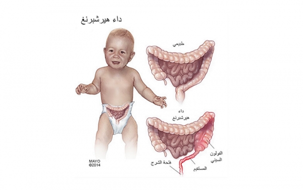 شلل القولون الولادي داء هيرشسبرونغ Hirschsprungs disease
